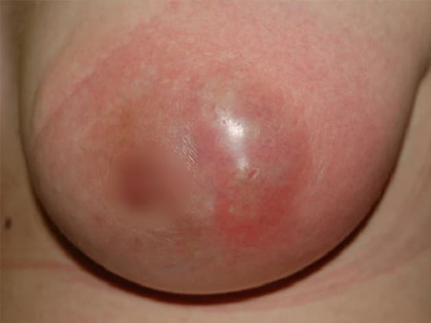 Đối với những trường hợp áp xe nặng, điều trị áp xe vú có thể cần chích, rạch. 