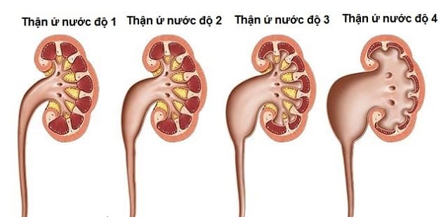 Điều trị sỏi thận ứ nước như thế nào 