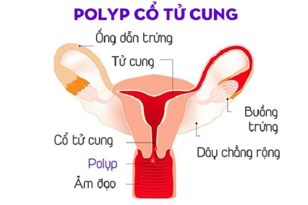 Polyp cổ tử cung là tình trạng các khối u thịt li ti xuất hiện trên cổ tử cung