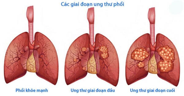 Giá tầm soát ung thư phổi và những vấn đề xung quanh