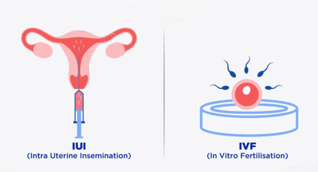 iui và ivf là gì?