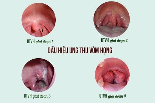Tầm soát ung thư vòm họng khám những gì