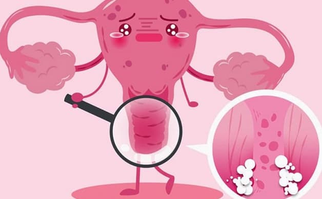 Khí hư có lẫn máu giữa chu kỳ là biểu hiện của bệnh viêm âm đạo