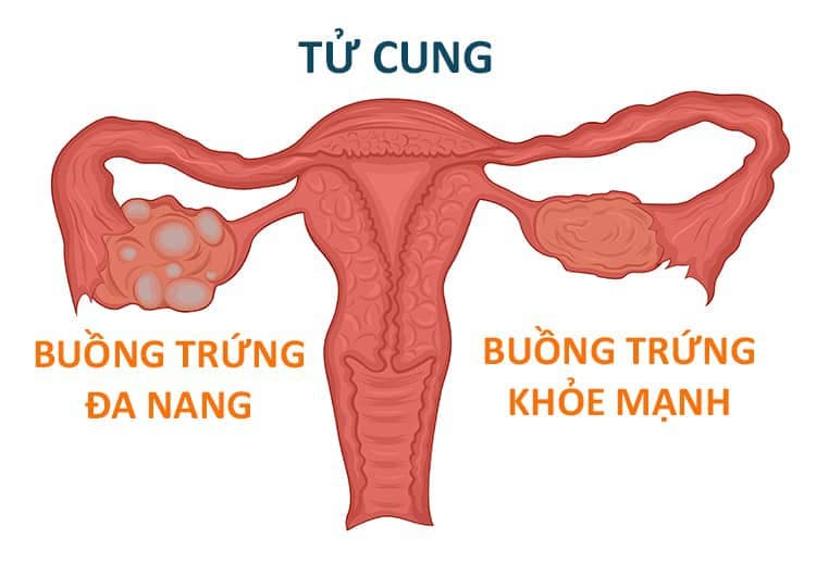 Buồng trứng đa nang khiến lượng androgens tăng lên quá mức, gây ảnh hưởng tới chu kỳ kinh.