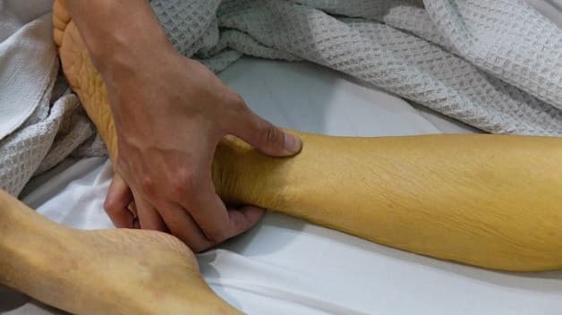 Viêm gan C có chữa được không?