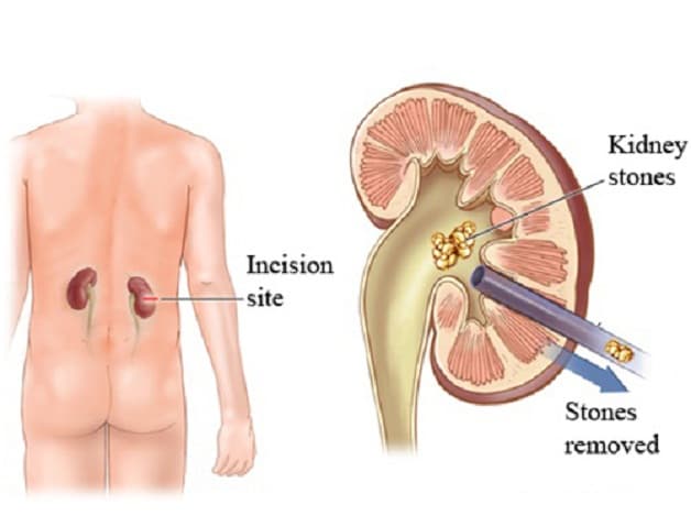 Mổ lấy sỏi thận qua da an toàn, xâm lấy tối thiểu, hiệu quả cao