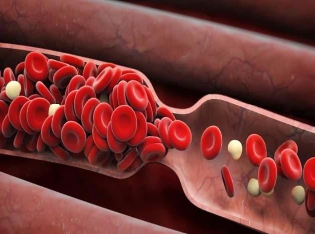 Các vấn đề mạch máu có thể là nguyên nhân gây đau nửa đầu nhức mắt phải