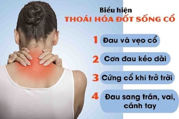 Thoái hóa đốt sống cổ chèn ép dây thần kinh gây đau đầu vai gáy.