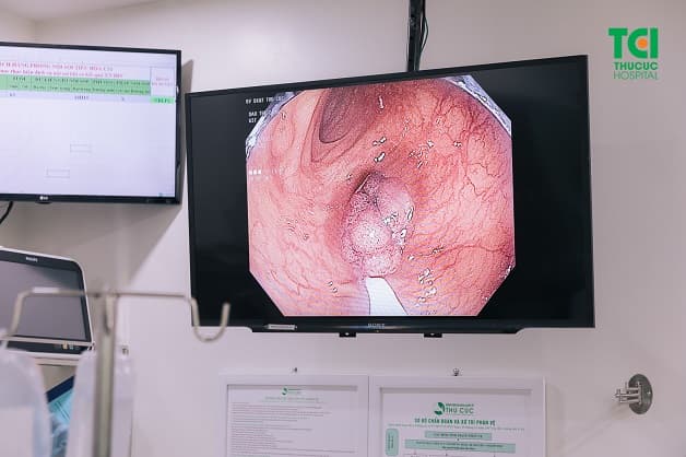 Cắt polyp trong nội soi dạ dày