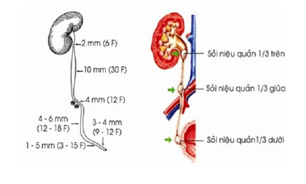 Thông tin khái quát về các phương pháp nội soi lấy sỏi niệu quản. 