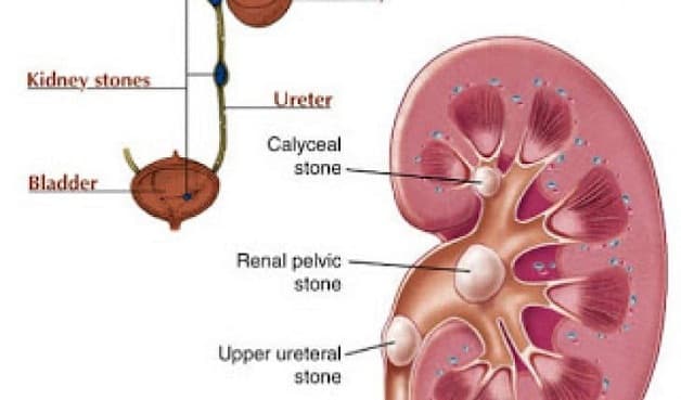 Nội soi sau phúc mạc lấy sỏi là phương pháp phẫu thuật ít xâm lấn, điều trị hiệu quả cao