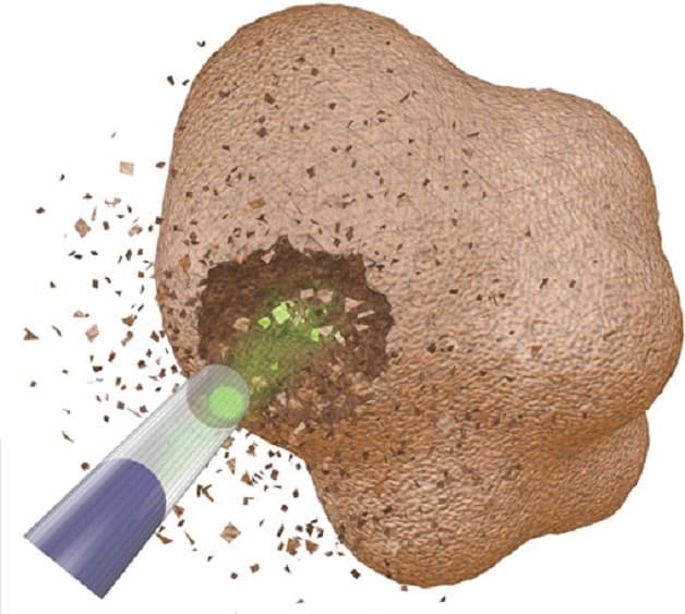 Điều trị nội soi lấy sỏi bàng quang ngược dòng không xâm lấn, dùng năng lượng laser để tán vụn sỏi