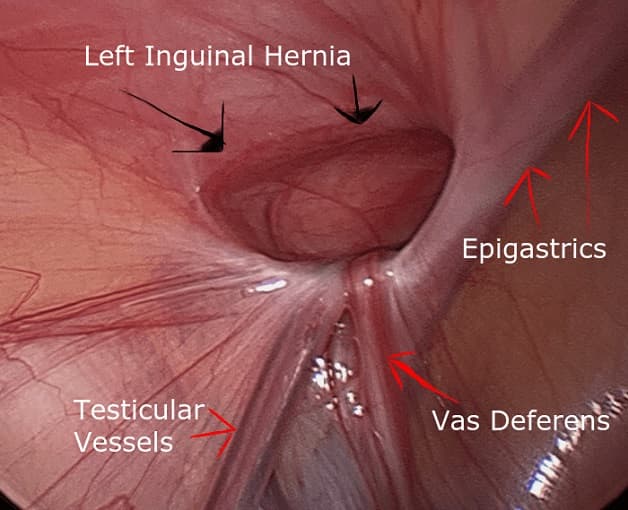 Điều trị thoát vị là một trong những phẫu thuật phổ biến nhất được thực hiện ở Hoa Kỳ