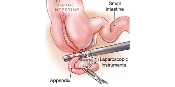 Phẫu thuật cắt ruột thừa.