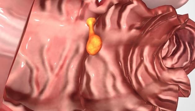 Polyp đại trực tràng