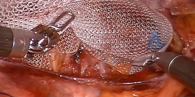 Cách chữa thoát vị vùng bẹn duy nhất là phẫu thuật và thường được thực hiện khi khối thoát vị tăng kích thước hoặc trở nên khó chịu