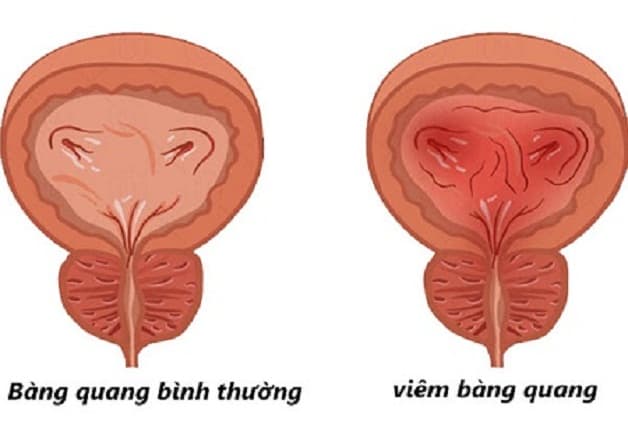 sỏi thận chạy xuống bàng quang có thể dẫn đến viêm bàng quang cấp