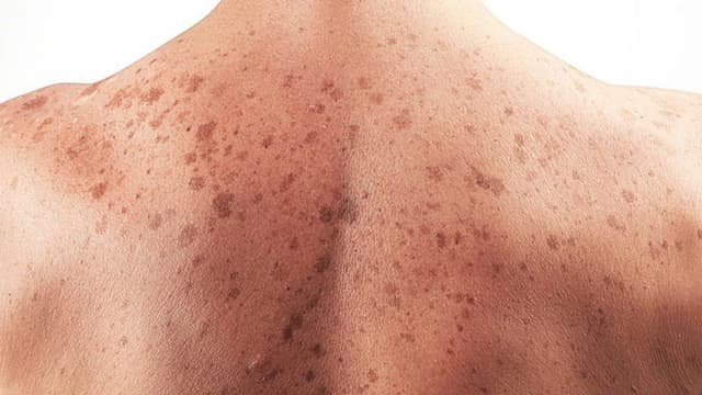 Tầm soát ung thư da và những vấn đề không nên bỏ qua