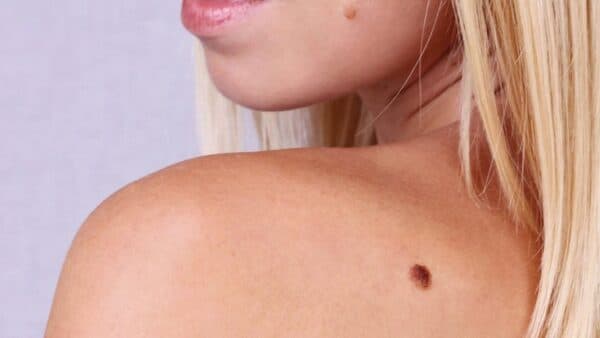 Tầm soát ung thư da ở đâu