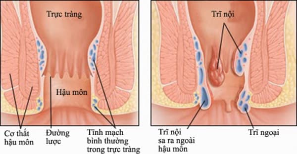 Tầm soát ung thư đại tràng như thế nào