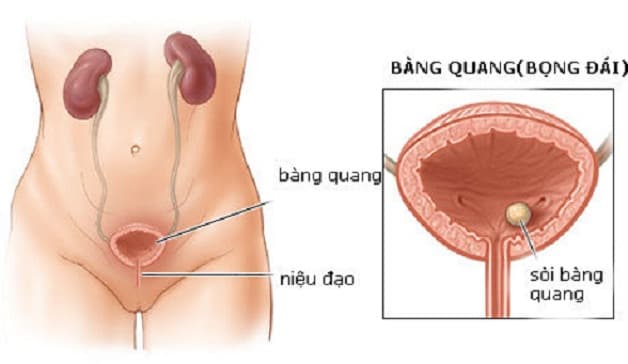 Sỏi bàng quang có kích thước lớn sẽ gây ra nhiều biến chứng nguy hiểm