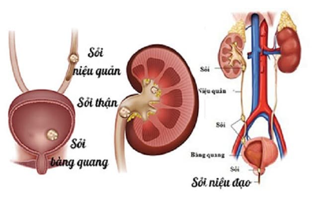 Tìm hiểu về phương pháp tán sỏi niệu quản 1/3 trên. 