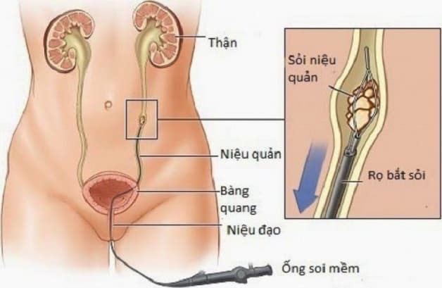 Tán sỏi nội soi ống mềm là phương pháp làm sạch sỏi theo đường tự nhiên