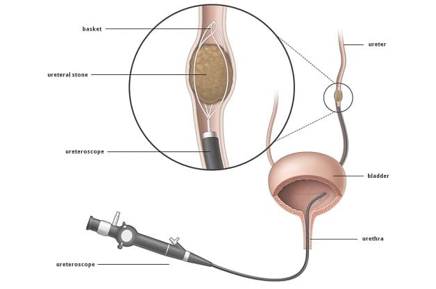 Tán sỏi nội soi ống mềm bằng laser giúp bảo tồn tối đa chức năng của thận
