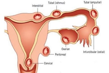 Mẹ bầu có biết: Thai ngoài tử cung nguy hiểm như thế nào?