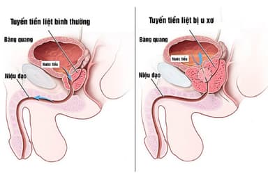 [Kiến thức y học] Phác đồ điều trị u xơ tiền liệt tuyến