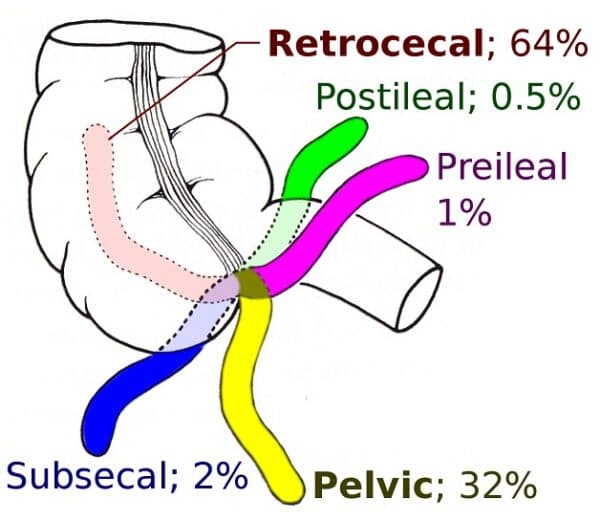 Ruột thừa là gì?