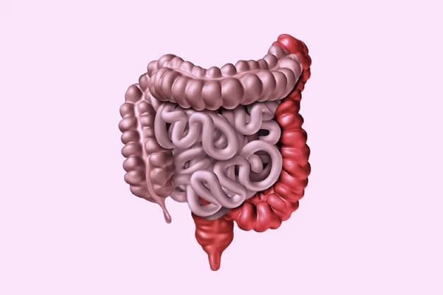 Viêm đại tràng trái