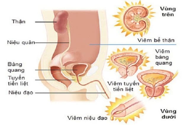 Viêm đường tiết niệu dưới là bệnh lý thường gặp ở nữ giới