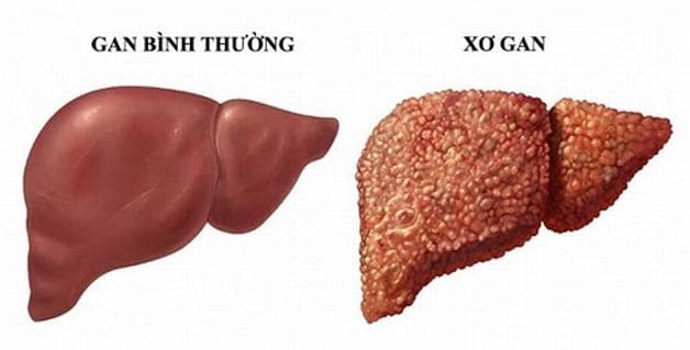 xơ gan f4 có nguy hiểm không