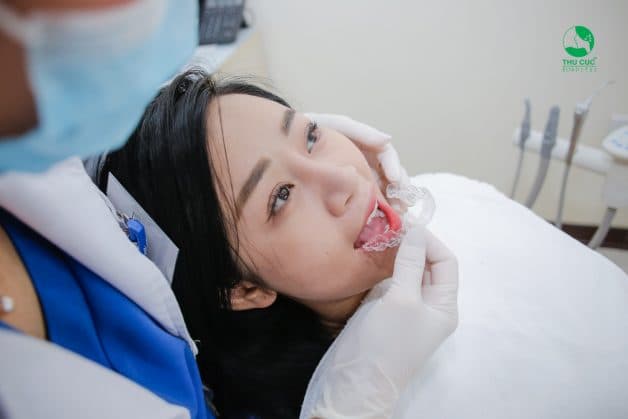 nieng-rang-invisalign
