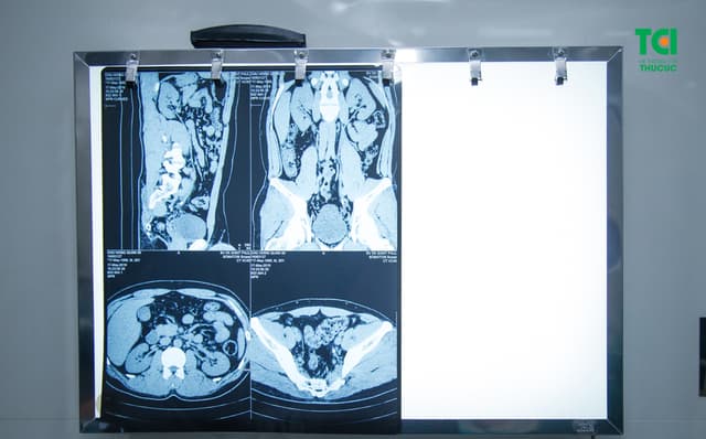 Tán sỏi công nghệ cao ít xâm lấn, sạch sỏi nhanh, êm ái