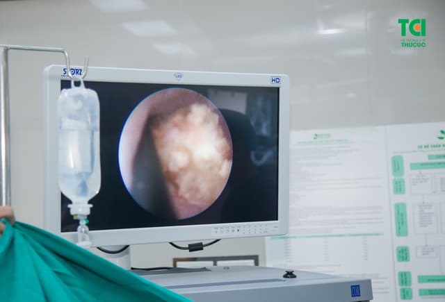 Tán sỏi công nghệ cao ít xâm lấn, sạch sỏi nhanh, êm ái