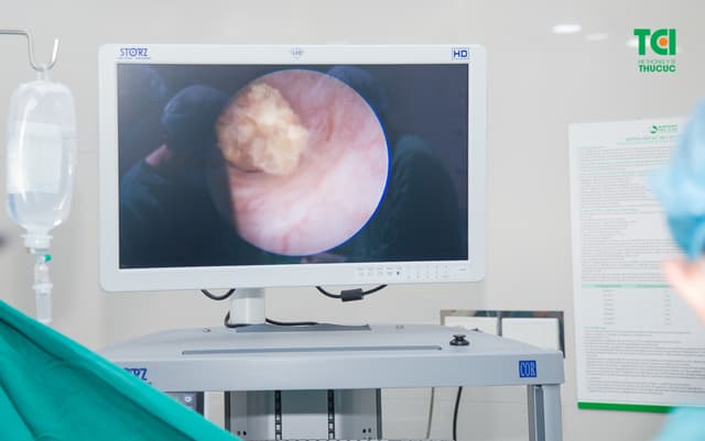 Tán sỏi công nghệ cao ít xâm lấn, sạch sỏi nhanh, êm ái