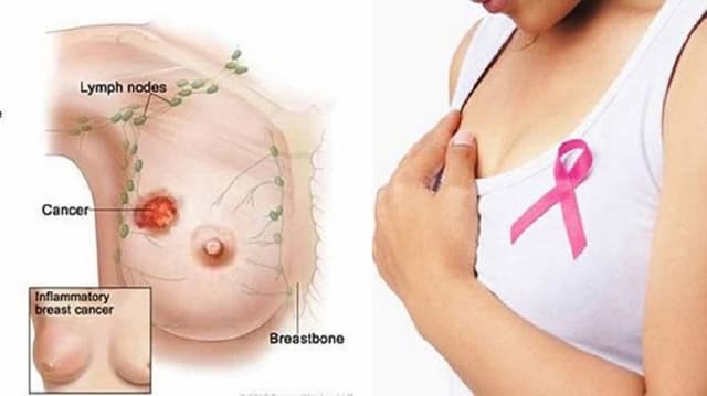 Áp xe vú sau sinh: Bệnh lý phổ biến ở các mẹ bỉm sữa