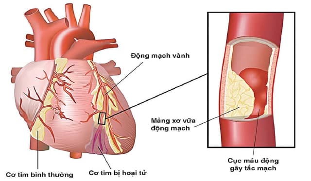 Bệnh xơ vữa mạch vành: Nguyên nhân và cách điều trị