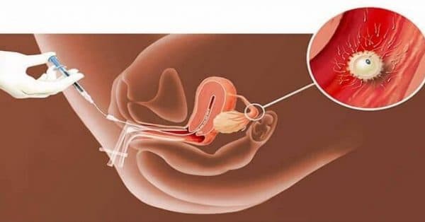 Bơm tinh trùng vào buồng tử cung không gây đau đớn gì