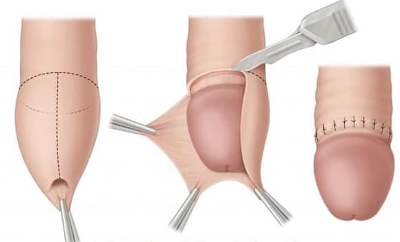 cắt bao quy đầu như thế nào