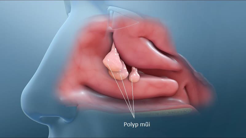 Hình ảnh polyp mũi