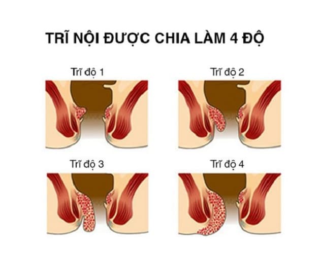 Cắt trĩ bao lâu thì lành là thắc mắc của nhiều người bệnh