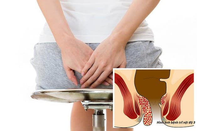 Tiến hành cắt trĩ nội độ 3 khi xuất hiện biến chứng