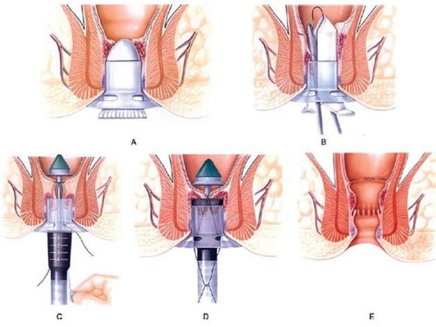 Cắt trĩ nội độ 3 theo phương pháp Longo hạn chế đau đớn, hạn chế tình trạng chảy máu hậu môn