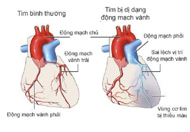 Những khiếm khuyết của động mạch vành có thể khiến mạch vành bị dị dạng