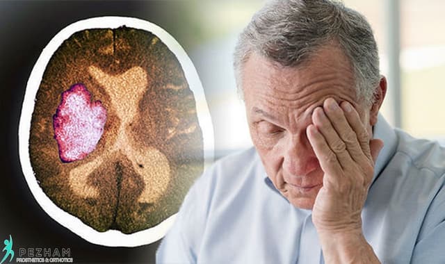 Nguyên nhân gây đột quỵ nhẹ, cách chẩn đoán và điều trị