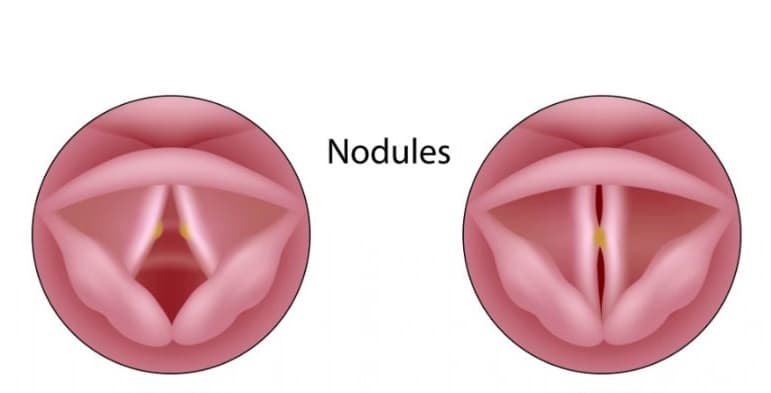 Hình ảnh thanh quản bị hạt xơ dây thanh