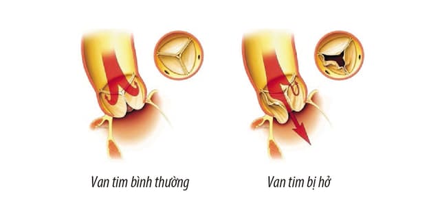 Hở 3 van tim là thế nào? Có nguy hiểm hay không?